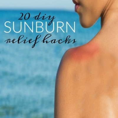 20 DIY Sunburn Relief Hacks